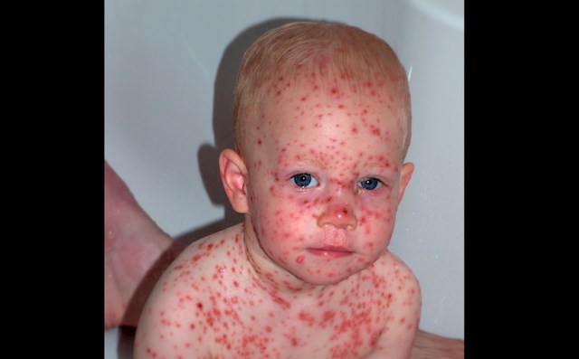 Cam așa arată la copii sau bebeluși. Pete mici, roșii, pe tot corpul. Touși depinde și dacă persoana bolnavă a primit vaccin sau nu. De regulă. la persoanele vaccinate, petele sunt mai rare și mai puțin roșii.