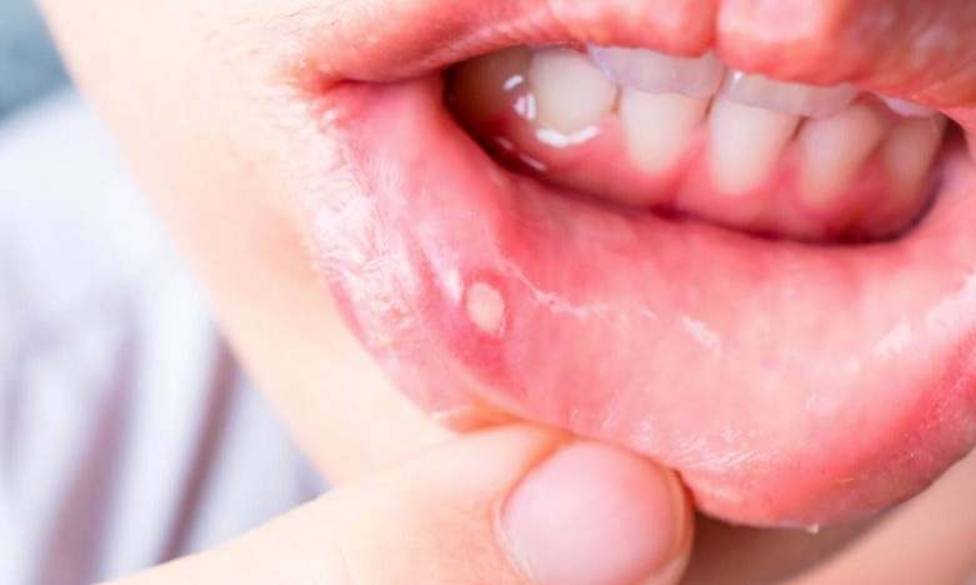 Mitől alakul ki az afta a szájban? | quanswer